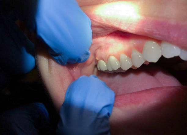 Best Emergency Treatment for Dental Infections or Abscesses in Baldwin City, KS